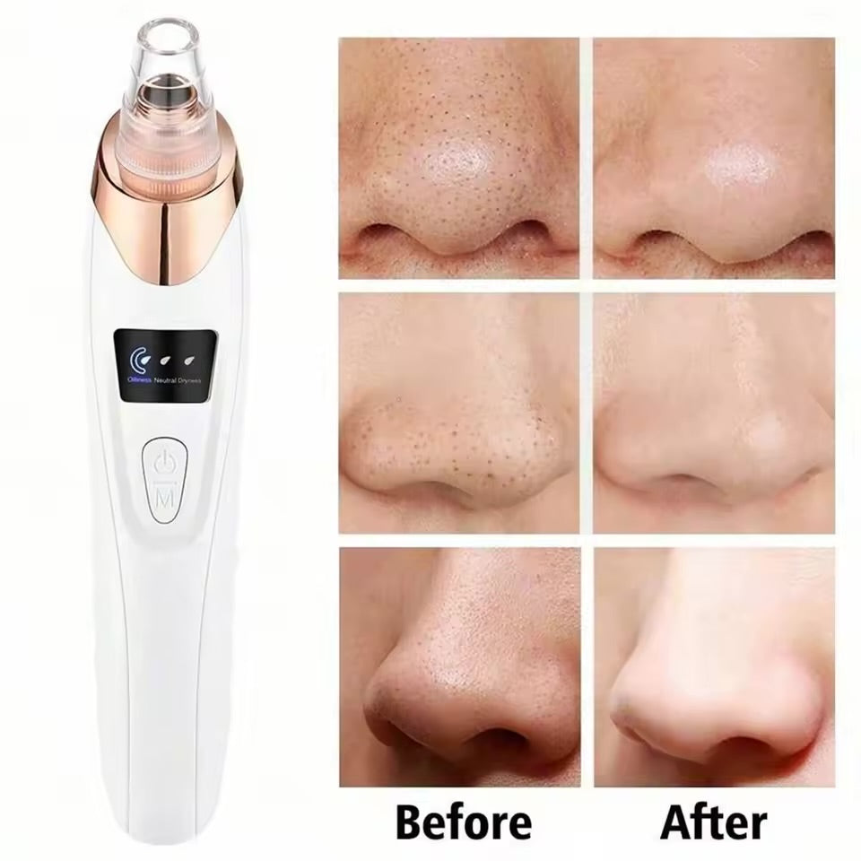 Effective Vacuum Pore Cleaner – Blackhead Remover & Facial Skin Care Device for Clear, Smooth Skin