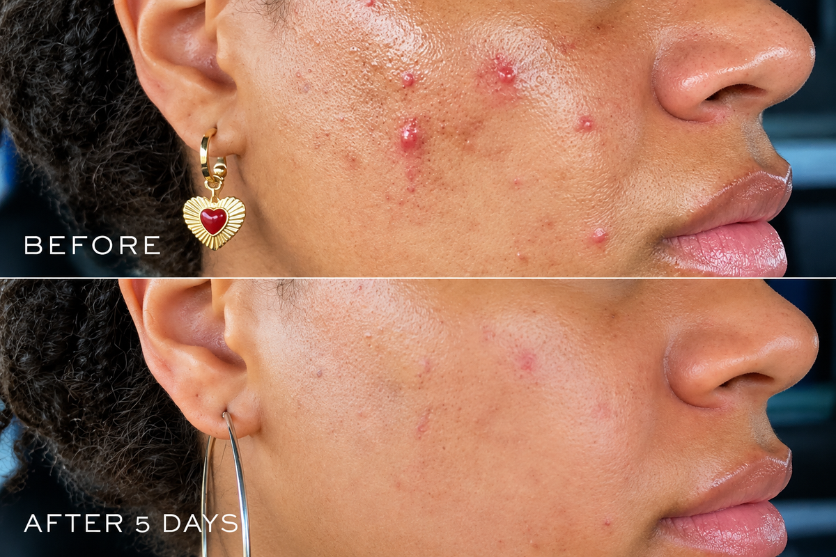 DIME Beauty Acne Spot Treatment – Salicylic Acid Blemish Gel for Oily & Acne-Prone Skin, 15 ml